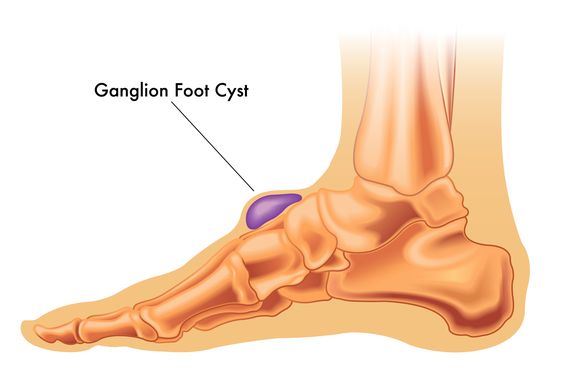 Ganglion Cysts: Causes, Symptoms, Diagnosis and Treatment